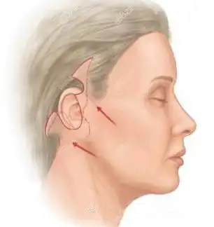 武汉诠美做小切口拉皮挺好做完快一个月伤口恢复蛮不错的