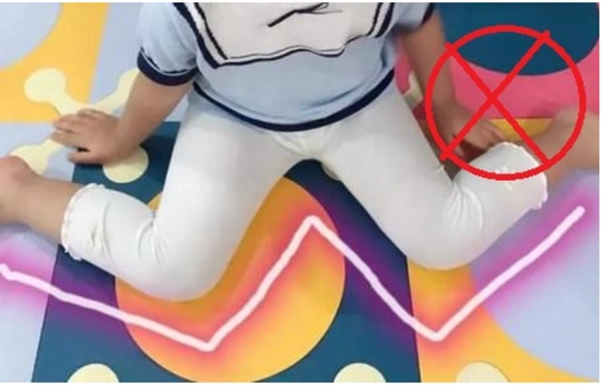 哈医大四院儿童康复中心:儿童内八字需要引起家长的重视!