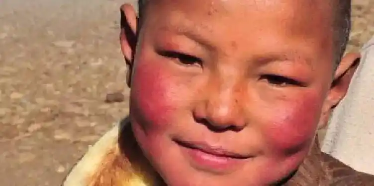 美丽的高原红, 怎么去除红血丝? | 皮肤