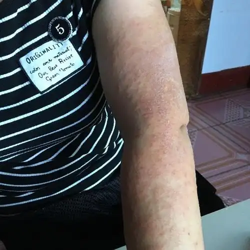 每年夏天皮肤就瘙痒.两个手臂.全是红色的泡,泡里面为黄色液体.事