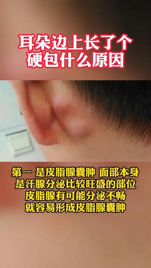 耳朵边上长了个硬包是什么原因
