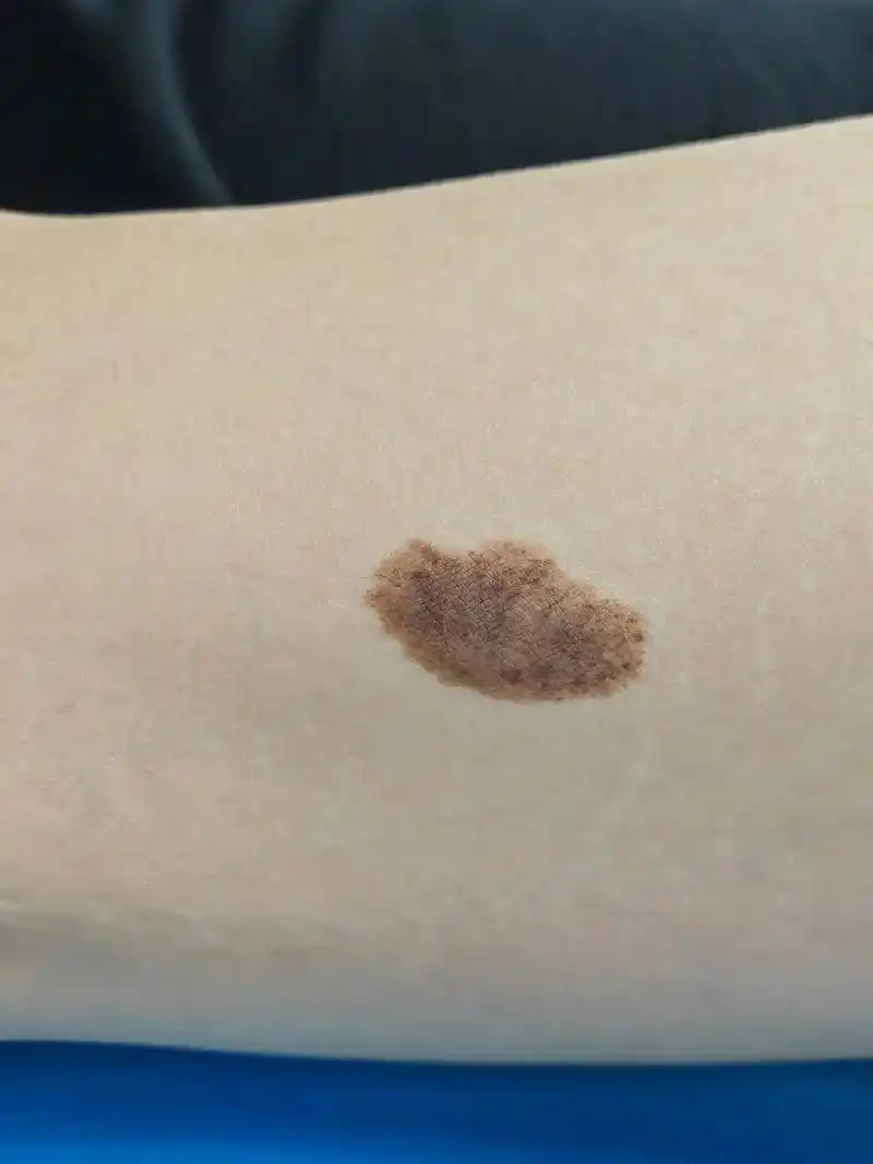 大腿,足底部色素痣手术切除#医学科普 #色素痣祛除 - 抖音