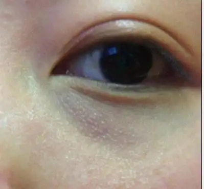 下眼睑这样怎么办?是脂肪粒?
