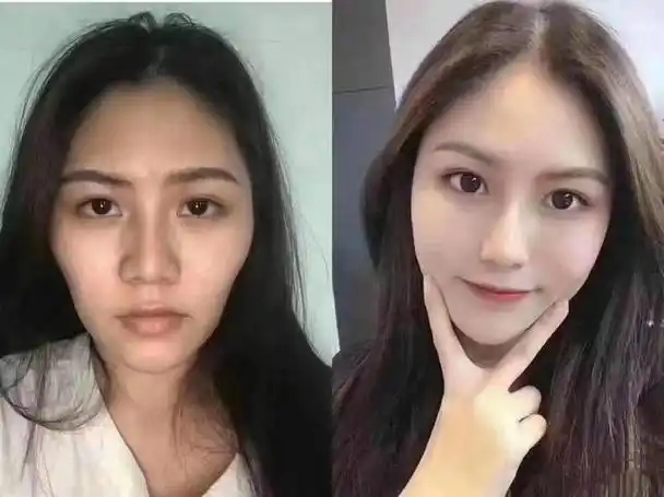 面部填充指南|哪些人不适合做面部脂肪填充?如何避免填充显假?