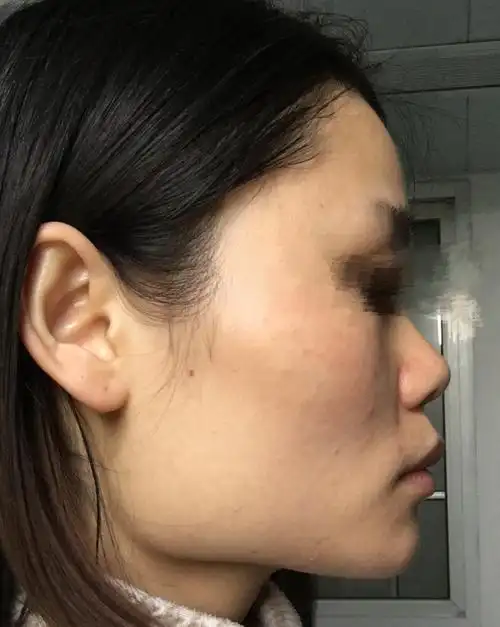 因为方脸脸宽下颌骨肥大而自卑怎么办该不该削骨