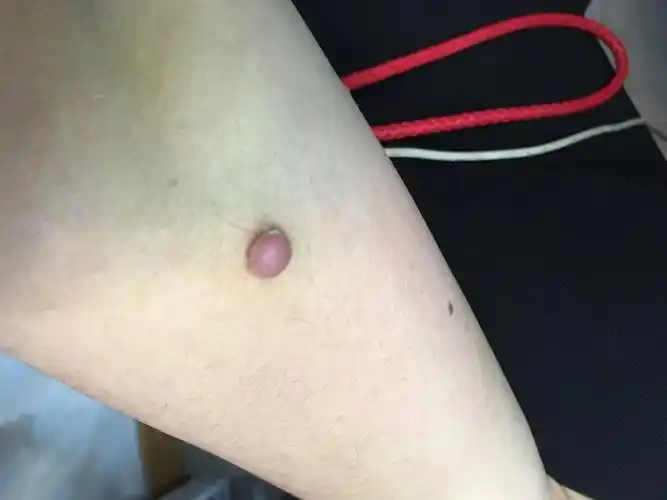 我手臂上长的这个疙瘩一样的东西是什么,要怎么治呢?
