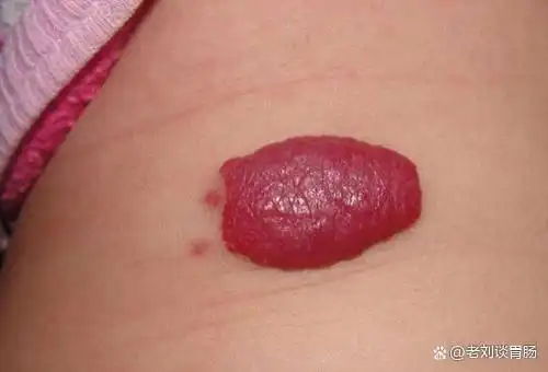 身体表面长出的肉疙瘩是肉瘤吗?