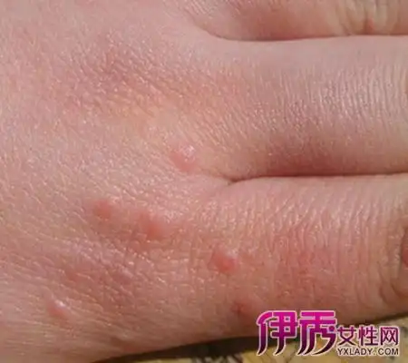 假尖锐湿疣初期图片欣赏 4种方法教你预防