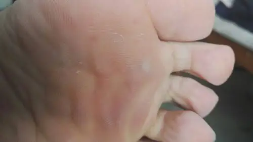 今天洗完澡发现脚底有一块发白的地方,不在表皮,而是在里面,用手一掐