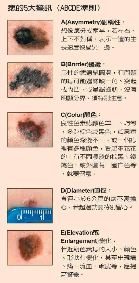痣或黑色素瘤?5大警讯助你判断