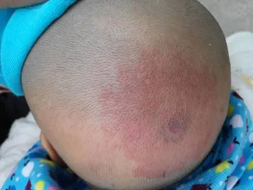 宝宝后脑勺有红斑,红斑中央还有一块像是破了的泡,怎麼回事啊?急死了