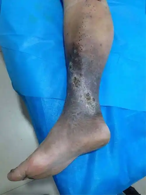 曾经就有一位"老烂腿"患者,小腿发黑,皮肤溃烂多年.