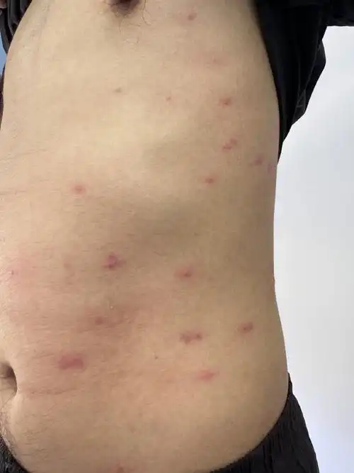 修皮匠聊皮肤病超话  今天,看的一个丘疹性荨麻疹(虫咬皮炎)的病人,被