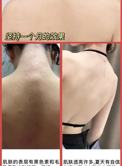 身体乳去鸡皮疙瘩全身磨砂膏提亮肌肤果酸补水鱼鳞去角质 750ml两瓶装