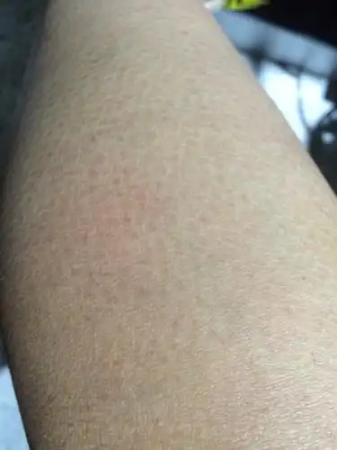 鱼鳞病,是一种遗传性角化障碍性皮肤疾病,主要表现为皮肤干燥