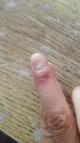 手指甲从根部裂开是什么原因,怎么办