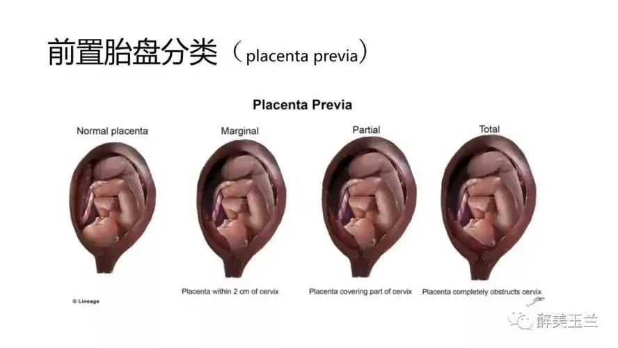 病例分享丨凶险性前置胎盘麻醉一例