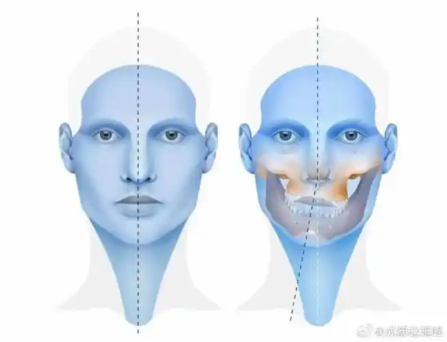 颌面整形赵延峰##下颌骨##面部轮廓##轮廓