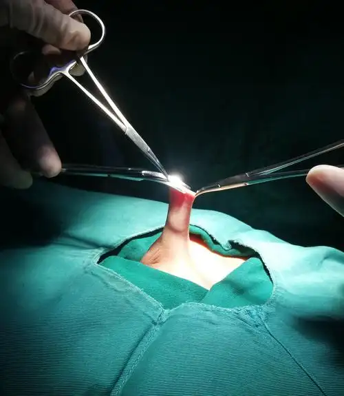 经包皮入路联合阴茎阴囊角重建隐匿阴茎矫形术