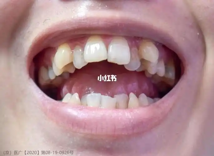 我的虎牙可以拔掉吗?