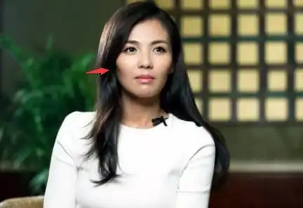 伤筋动骨100天!颧骨内推后都需要注意什么呢?