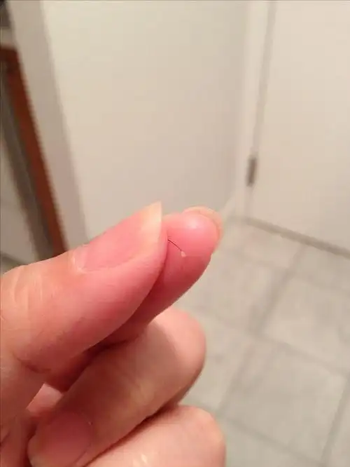 【求助】脱落头发的发根有白色固体?还有救吗?有图