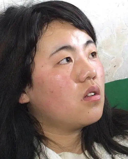 早上起床脸很肿是什么原因导致的?