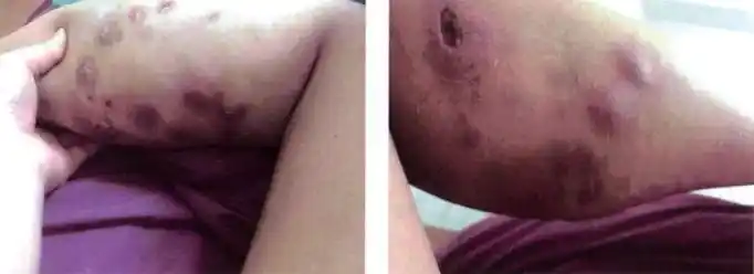 溶脂针减肥可导致全身溃烂溶脂针副作用讲解