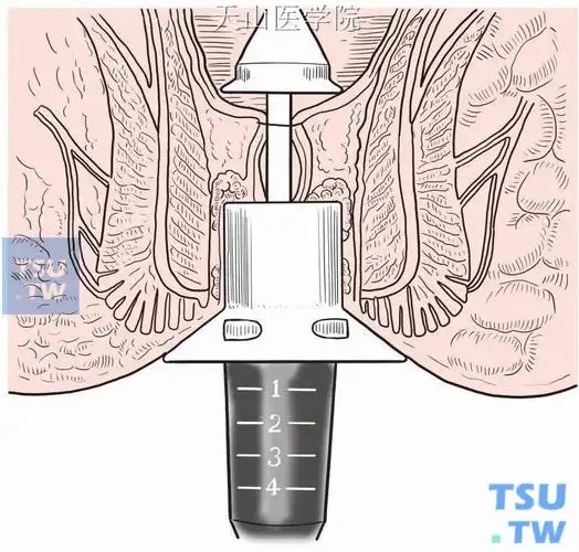 吻合器痔上粘膜环切术(pph)