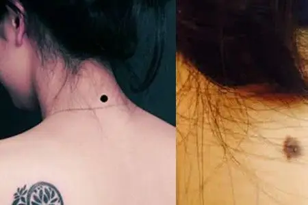 【图】脖子后面有痣代表什么意思 这些你了解吗