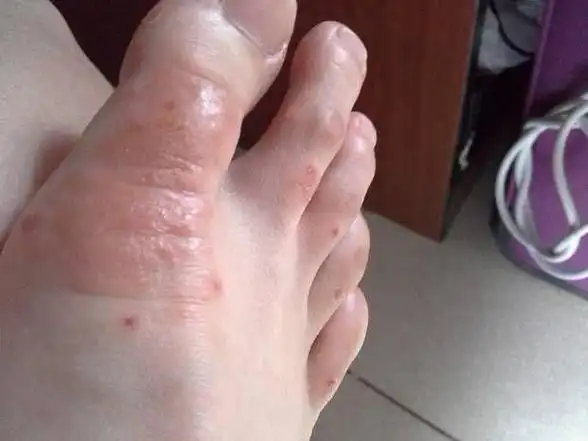 你的脚上也长小水泡很痒吗这里有解决办法