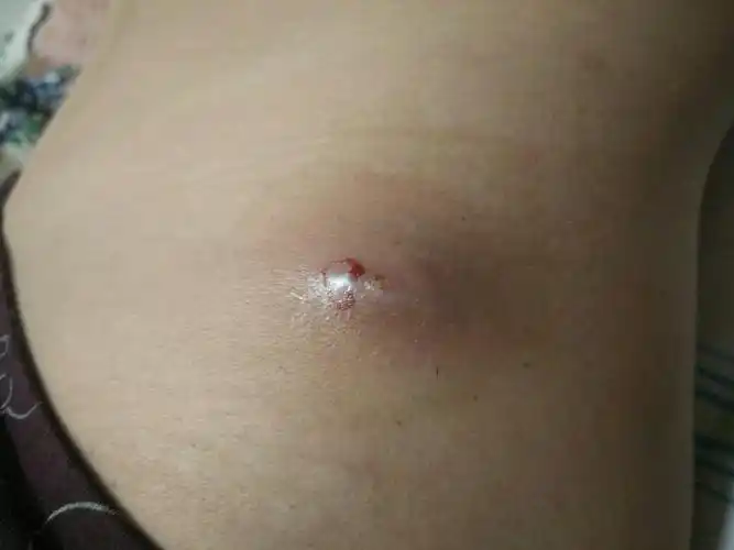 孩子腰胯部长了个疖子,求医,谢谢