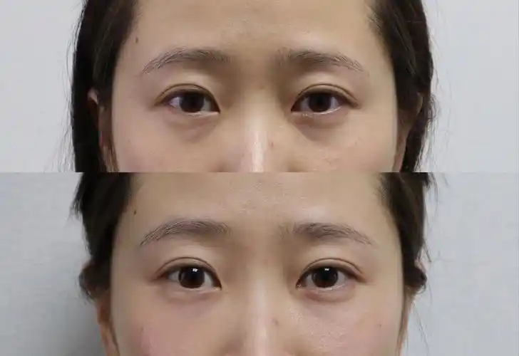 还能遮下黑眼圈,嗯,纠结了一下,最后还是选的嗨体,效果也不错,泪沟平