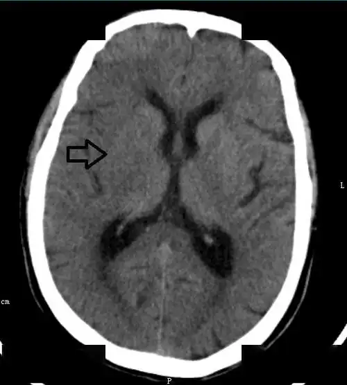 67超急性期大面积脑梗死ct平扫表现