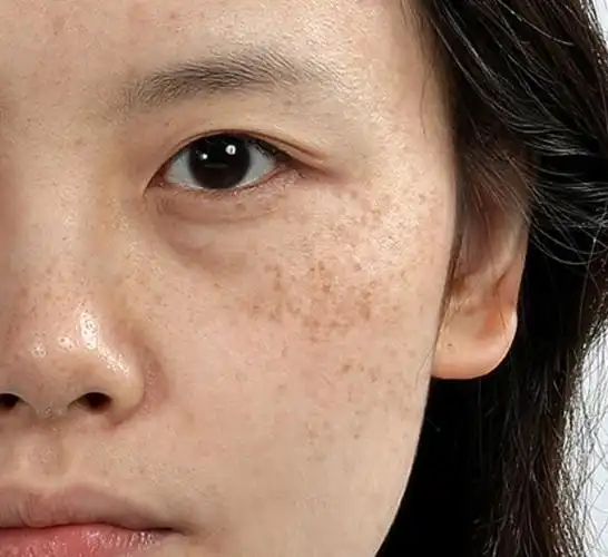 色斑淡化不掉照着教授说的做再深的色斑都有救