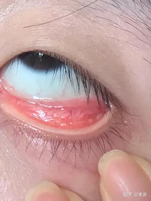 滤泡性结膜炎如何能有效治疗之前会怕光流眼泪眼干涩疼痛现在这些症状