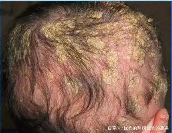 常伴有毛囊炎睑缘炎,面部常与痤疮酒糟鼻螨虫性皮炎并发脂溢性皮炎最