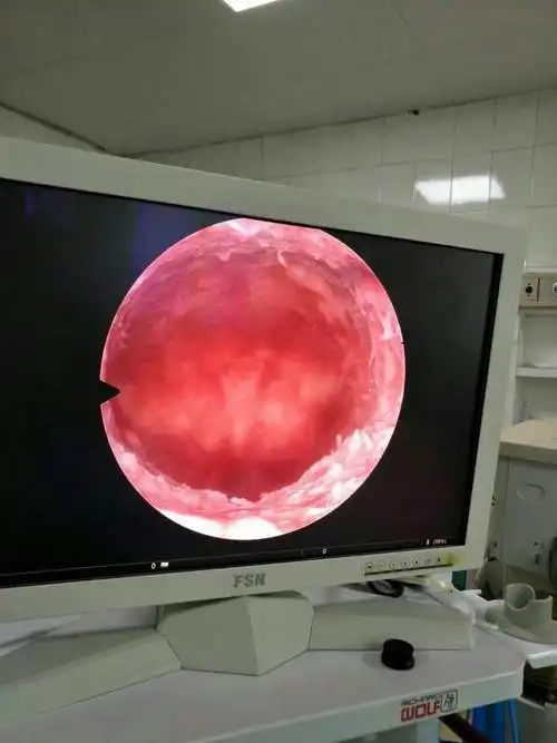 环嵌顿宫腔镜下取环