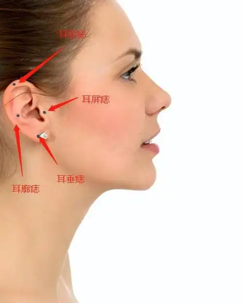 2,耳廓有痣   外缘上为智慧痣,擅长思考,深谙处世之道,比较精明.