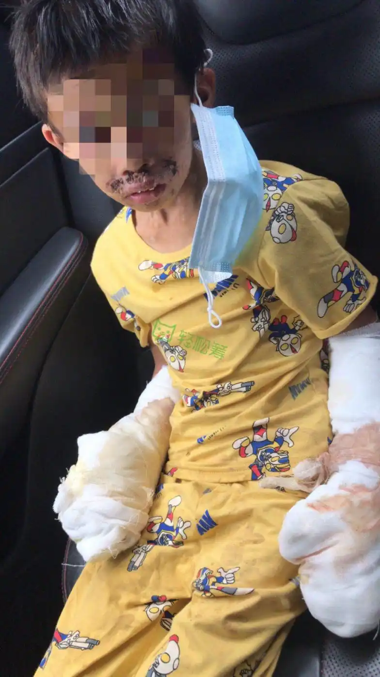 男童遭亲父烟头烫伤双手面临截肢已发起轻松筹求助筹到37万善款