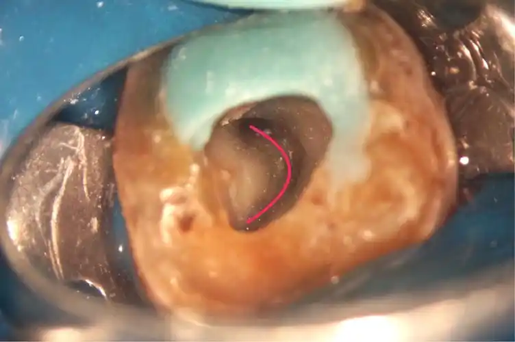 显微镜下治疗下颌第二磨牙慢性根尖周炎"c"形根管一例