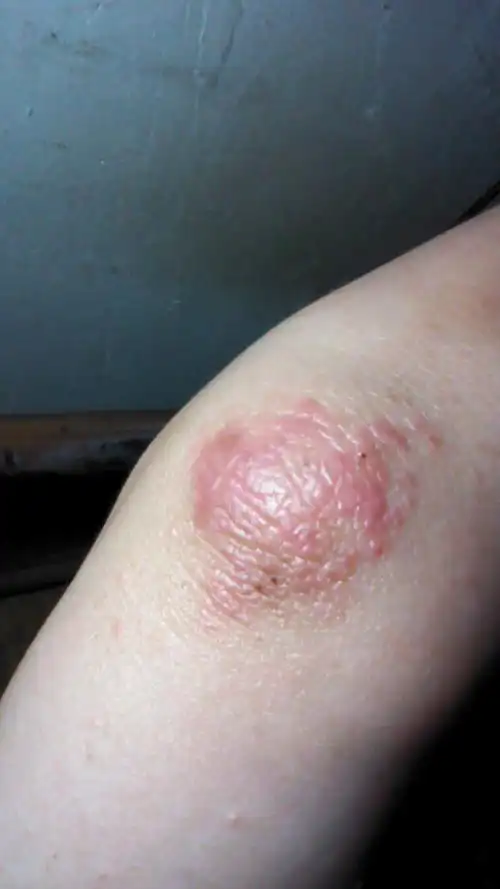 问:最近在健身,前几天肘部痒,这个是什么呀.会不会自己退下去呀