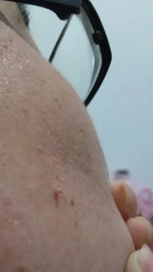 大家好,右脸中间部位肉粒粒,刚长了没一个月,不