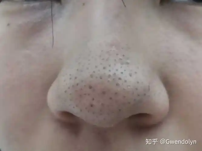 女孩子鼻子上有黑头很自卑,大家怎么处理的啊? - 知乎