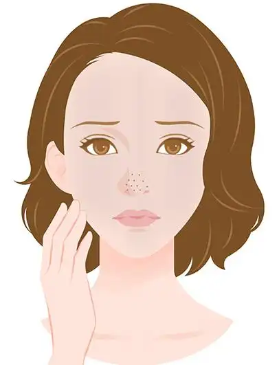 上层的角质细胞软化,剥离,能够融掉老化的角质细胞和毛孔内的阻塞皮脂