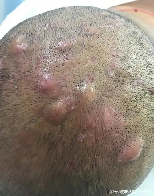 秃发姓毛囊炎