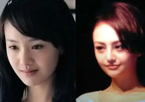 【图】网传郑爽取出鼻子假体 自称后悔整容