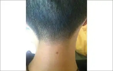 1,男人脖子痣相图解男人脖子左边长痣:其实对于男人在脖子左边长痣的