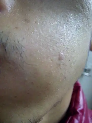 我脸上长一小块不知什么东西 凸起 直径大概0.