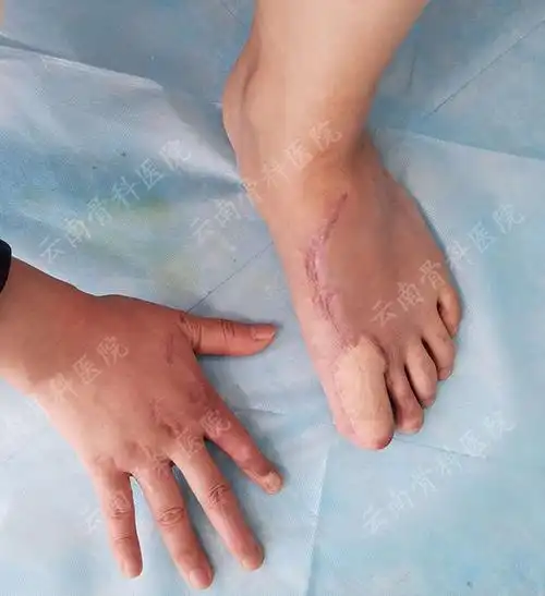 手指再造案例专集